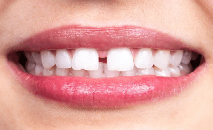 Advantages of Invisalign for Gap Teeth